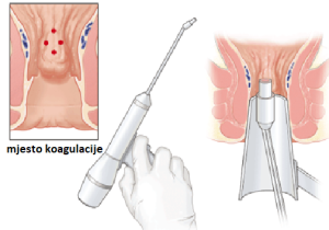 Infracrvena koagulacija hemoroida (IRC)