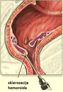 Sklerizacija hemoroida