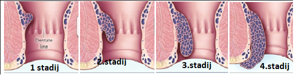 stadiji hemoroida