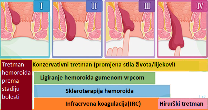 tretmani hemoroida